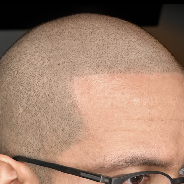 Scalp