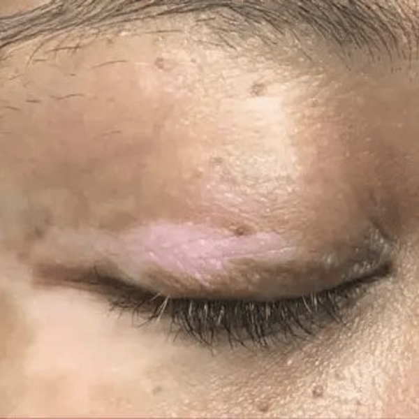 Scar